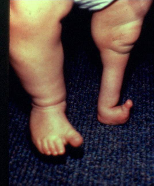 Fibular Deficiency (anteromedial bowing) Pediatrics Orthobullets